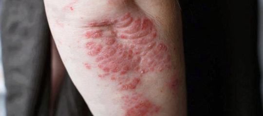 traiter le psoriasis