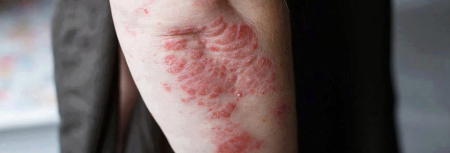 traiter le psoriasis